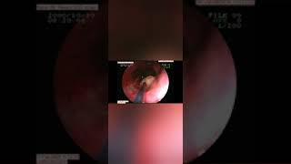 OGD Scopy with Sclerotherapy for Esophageal Varices [upl. by Wandie]