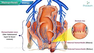 Hemorrhoids Animation Etiology Clinical features Grading of Internal Hemorrhoids Management [upl. by Branch]