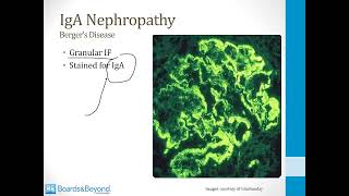 Nephritic syndrome [upl. by Shayna]