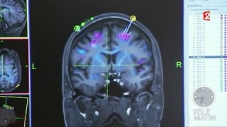 Sciences  Des ondes magnétiques pour stimuler le cerveau sans opération [upl. by Idroj]