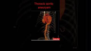 Thoracic Aorta Aneurysm  CECT Chest shorts aorticaneurysm radiology [upl. by Thackeray]