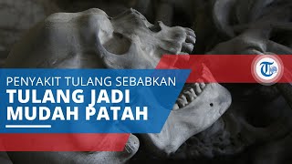 Osteogenesis Imperfecta Penyakit Tulang Sebabkan Keadaan Tulang Sangat Rapuh dan Mudah Patah [upl. by Yaron]