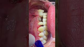 Simple Gingivectomy using diathermy surtron 50 watt dentist brace orthodontics dental teeth [upl. by Petrina]