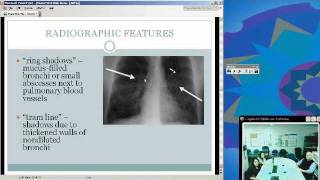 Allergic Bronchopulmonary Aspergillosis Sunena Argo MD [upl. by Marianne521]