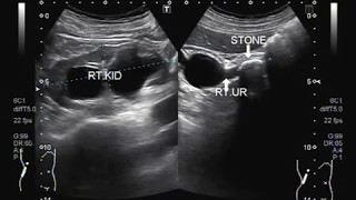 Ultrasound Video showing a large stone in ureter near PUJ [upl. by Atived]