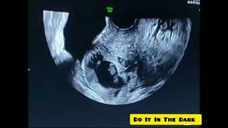 viable ectopic pregnancy in previous CS scarradiography ultrasound radiologyDoItInTheDark [upl. by Marion]