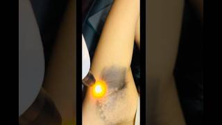 blackness underarms laser treatment permanent treatment 100 laser skin glowingskin shrots [upl. by Einattirb59]