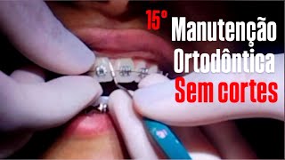 A MANUTENÇÃO DE APARELHO ORTODÔNTICO MAIS COMPLETA DO YOUTUBE 🦷🔥 15° [upl. by Ashleigh]