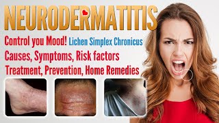 Neurodermatitis Causes Symptoms Treatment Prevention and Home remedies  Lichen simplex chronicus [upl. by Sorenson]