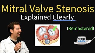 Mitral Valve Stenosis Diagnosis Treatment Pathophysiology [upl. by Aleihs]