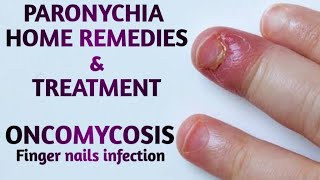 Paronychia Home remedies  Finger nail infection  skin infections  paronychia  finger infection [upl. by Pelson943]