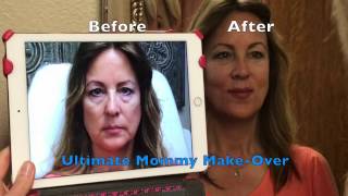 LIQUID FACELIFT  ULTIMATE Dermal Filler MAKEOVER [upl. by Lasiaf899]