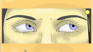 Cranial Nerve 6 palsy [upl. by Enitsenre804]