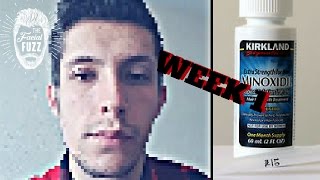 Minoxidil Beard  Week 1  Minoxidil 5 for Beard Growth  Facialfuzzfridays [upl. by Barram]