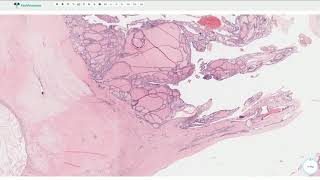 Multinodular Goiter  Thyroid Gland Histopathology [upl. by Alisun]