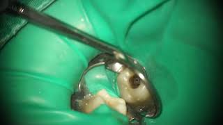 Root canal treatment Patency and Gilde Path [upl. by Ahseyt]