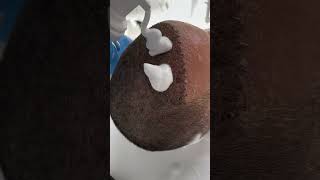 Head wash after hair transplant treatment contact us 919041785999 hairtransplant india [upl. by Ecnerwaled]