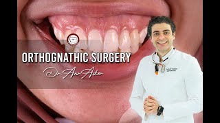 Orthognathic Surgery [upl. by Skcirdnek804]