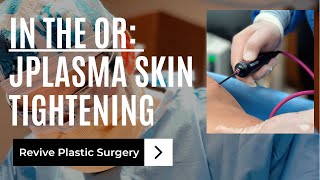 In the OR JPlasma Skin Tightening [upl. by Clift]