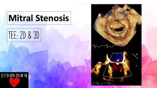 Mitral Stenosis [upl. by Knighton]