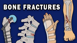 BONE FRACTURES [upl. by Cohl]