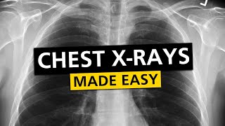 Chest X Rays CXR Made Easy  Learn in 10 Minutes [upl. by Donavon]