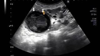 Ultrasound Video showing a large Hydatid cyst in kidney [upl. by Holder]