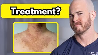 How to Treat Tinea Versicolor  Dr Dustin Portela [upl. by Richlad]