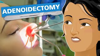 Adenoidectomy [upl. by Adriano766]