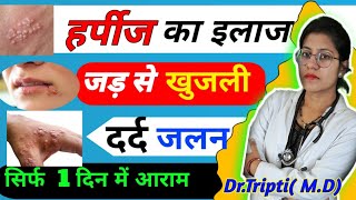 हर्पीज क्या है होम्योपैथिक इलाज  Homeopathic Treatment of Harpes in Hindi DrTripti [upl. by Renault703]