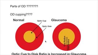 1 PapilledemaOptic disccup2 papilledema stages cf labs httpsyoutubeqQDON7DFBwY [upl. by Alorac]