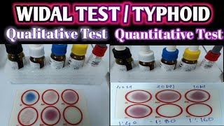 Widal Test Practical  Qualitative Widal Test  Quantitative Widal Test  Typhoid Test [upl. by Salba104]