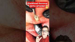 Crazy BLACKHEADS REMOVAL Fail shorts [upl. by Merriman]