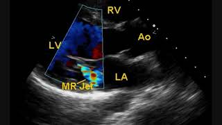 Post BMV Echocardiogram [upl. by Lyrej]