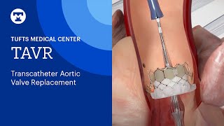 TAVR Transcatheter Aortic Valve Replacement  Tufts Medical Center [upl. by Raimes]