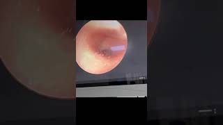 GROMMET INSERTION UNDER ENDOSCOPIC VISUALIZATION [upl. by Enerod419]