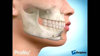 Chin Augmentation Surgery Genioplasty [upl. by Heymann795]