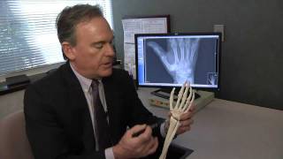 Treating Basal Thumb Joint Arthritis  Mayo Clinic [upl. by Mochun]