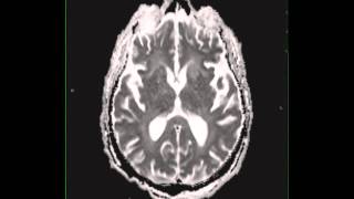 Cryptococcal meningitis [upl. by Farhi]