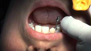 Perform the Ultimate Atraumatic Extractin with the Easy X Trac System [upl. by Ytinav]