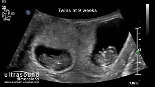 Scan of the Week Twins at 9 weeks gestation [upl. by Ponzo]