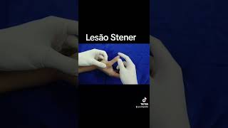 Lesão de Stener  Ruptura do Ligamento Colateral Ulnar [upl. by Crespi800]