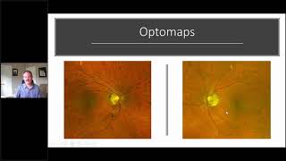 Using the RETeval ERG for Glaucoma w Dr Mike Cymbor OD [upl. by Ihpen]