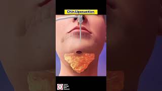 Chin Liposuction [upl. by Ecnarf]