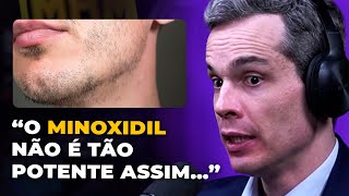 ESPECIALISTA revela A VERDADE sobre o MINOXIDIL [upl. by Oilerua]