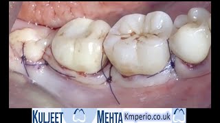 Periodontal surgery Lower right molars [upl. by Aihsenal]