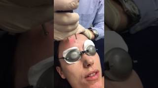 Erbium Yag Laser Treatment using Asclepion MCL31 Dermablate [upl. by Nelleus]