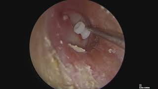 Endoscopic Myringotomy with Grommet insertion [upl. by Jotham]