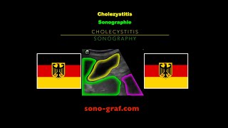 Sonographie  Cholezystitis [upl. by Suoirrad]