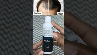 Minoxidil Hair Regrowth Results  Minoxidil Unboxing  minoxidil beard growth  minoxidil minokem f [upl. by Baudin]